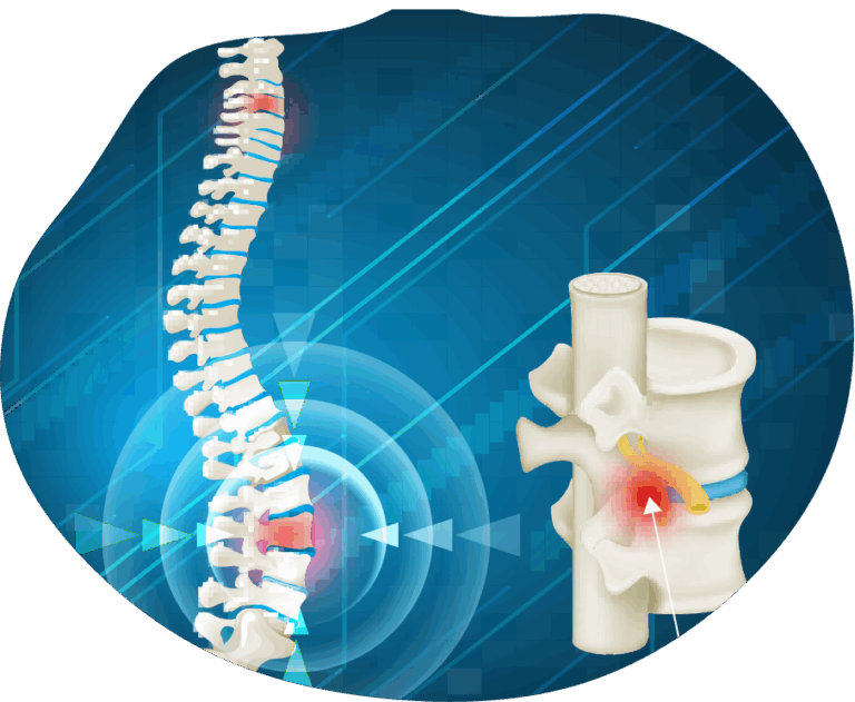 Herniated Disc & Back Pain – Causes & Treatment