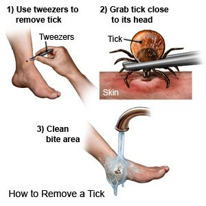 How can you prevent infection after a tick bite
