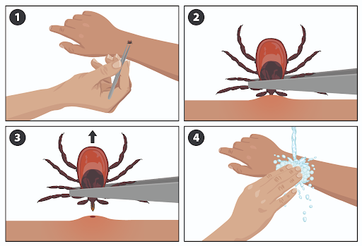 What are the first steps after a tick bite