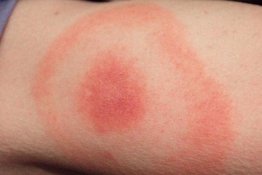 High TGF Beta 1 in Lyme Disease: What Your Labs May Be Revealing