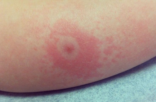 Lyme Disease and Psoriasis: Is Your Skin Telling You Something?