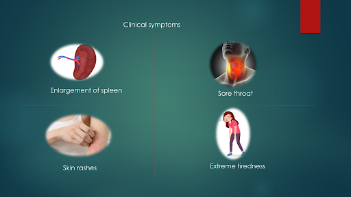 infectious mononucleosis