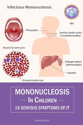 infectious mononucleosis