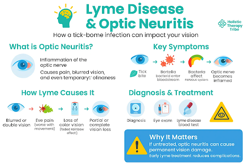 Lyme Disease and Optic Neuritis