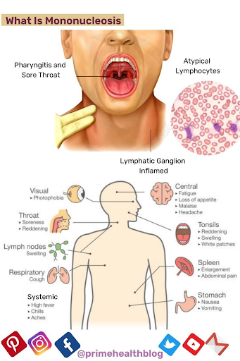 Lyme Disease and Mononucleosis: Understanding the Overlap