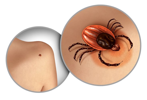 In Contrast to Lyme Disease: How Rocky Mountain Spotted Fever Tells a Different Story